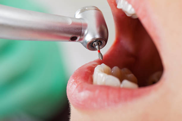 Best Broken or Chipped Tooth Repair in Groton, SD